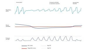 minuut-beademing-aircurve10cs-pacewave-resmed